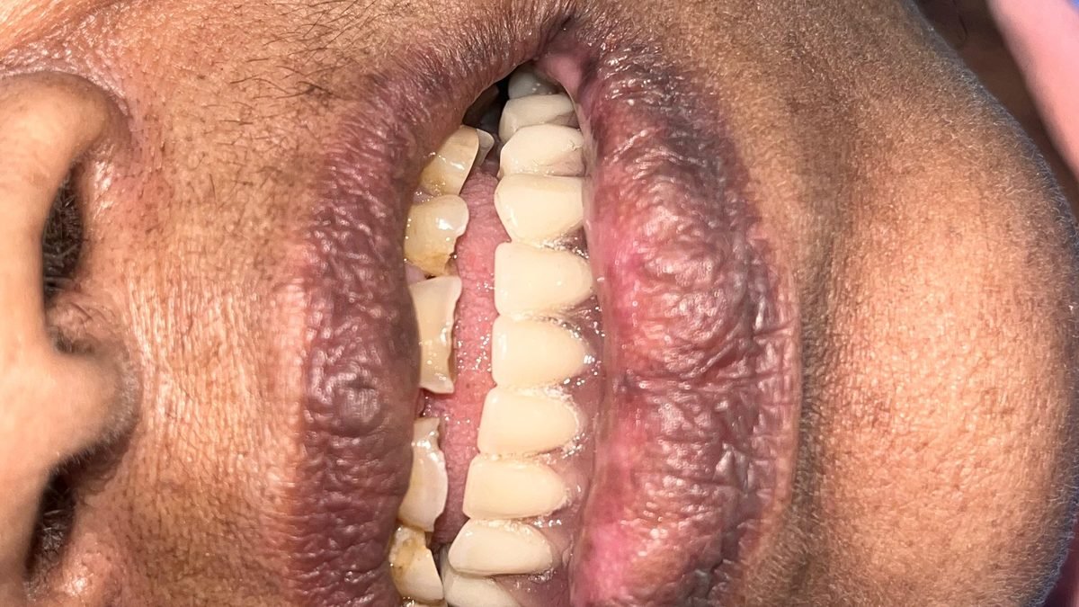 After full teeth restoration