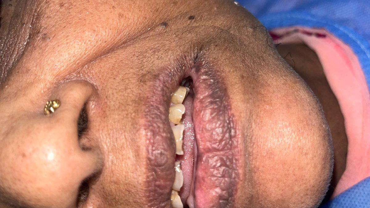 Before treatment