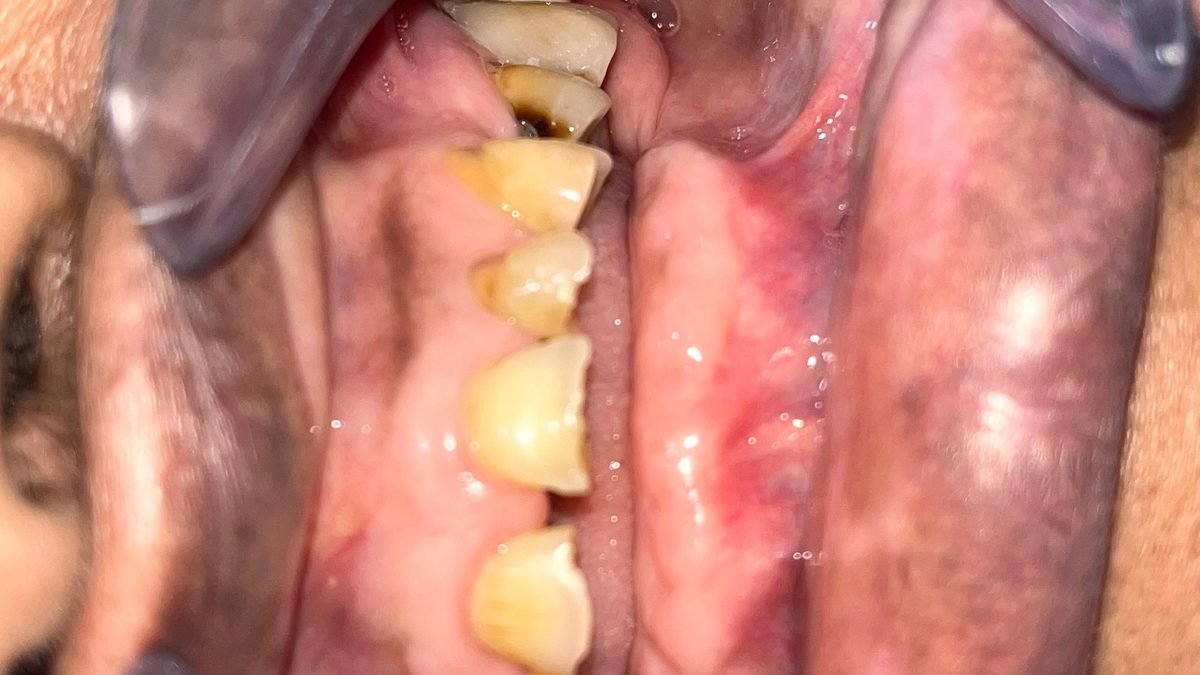 During treatment