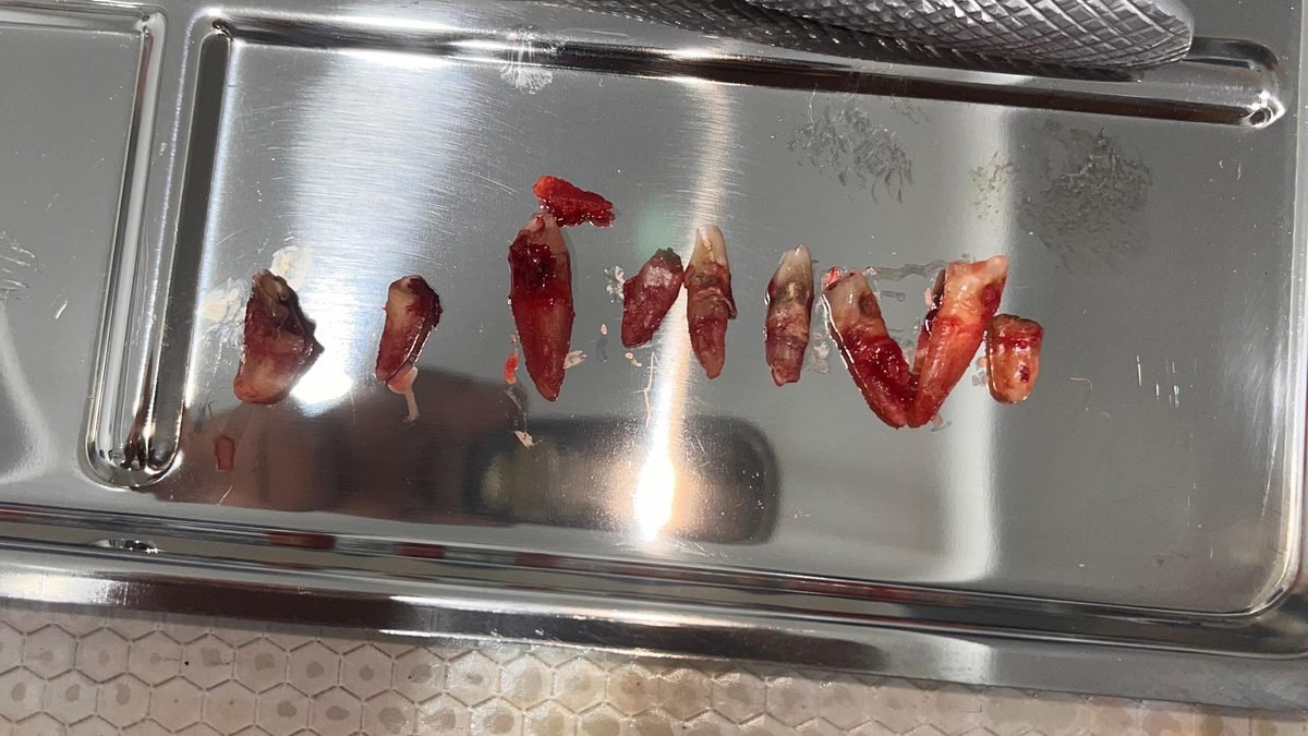 Extracted teeth