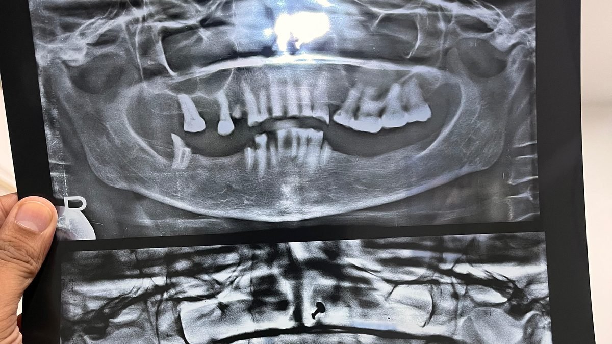 Full mouth rehabilitation case - X-ray
