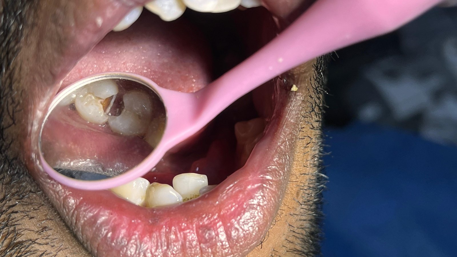 Composite restoration case - before